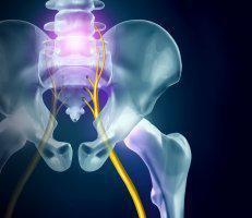 Sciatica